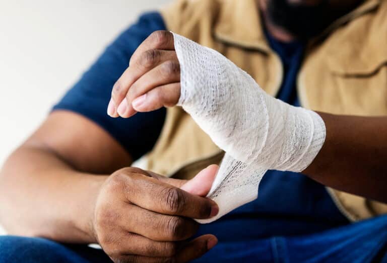 What are the most common ways burn injuries happen?